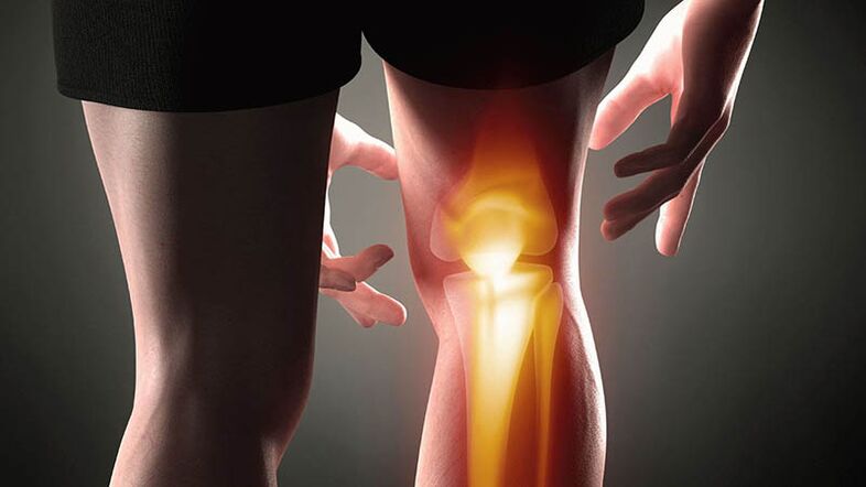Arthrosis of knee joints