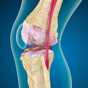 Excessive stress of the thigh muscles causes knee pain
