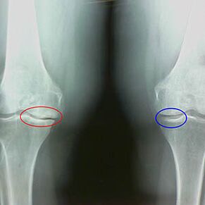 Knee joint disease on X -ray