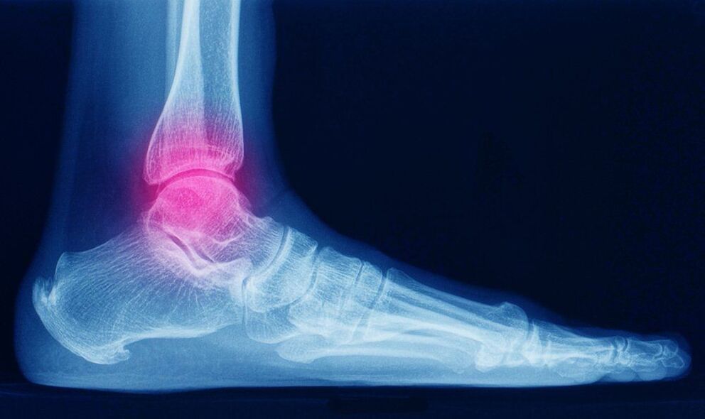 Ankle arthritis symptoms