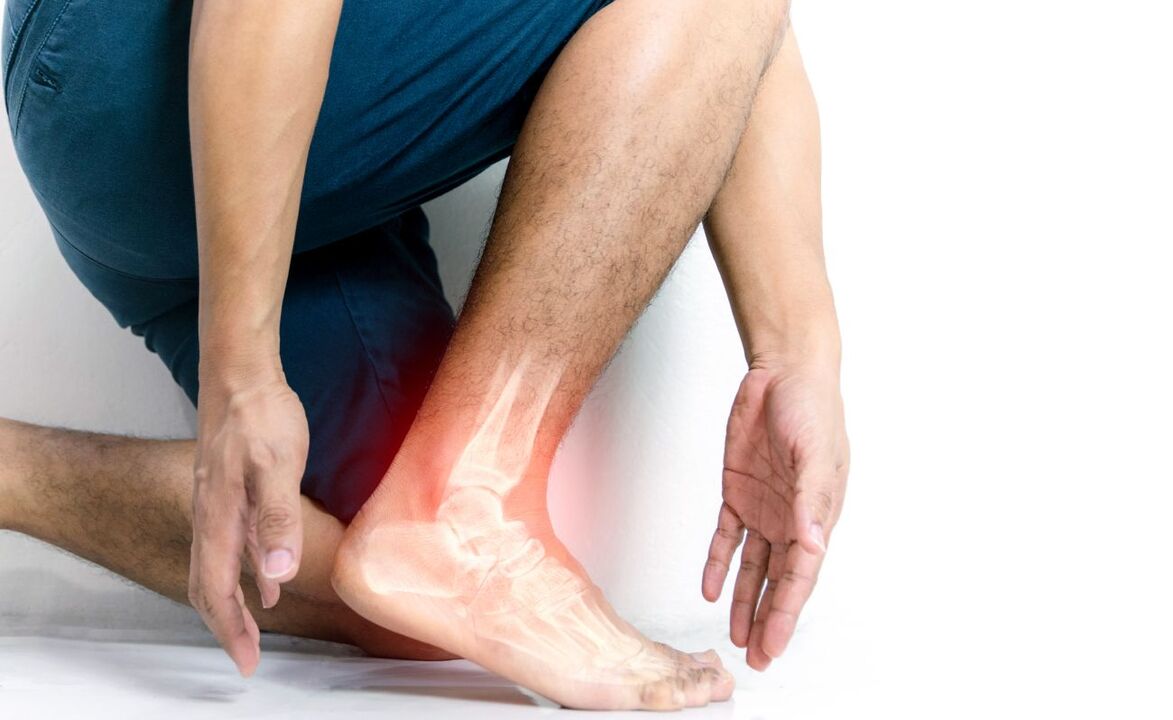 Classification of ankle arthritis